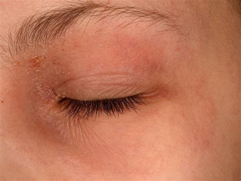 Eyelid Dermatitis (Eczema): Symptoms, Causes, And Treatment, 59% OFF