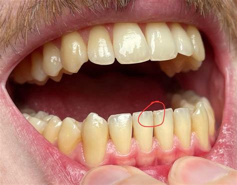 Noticed this on my incisor, cause for concern? : r/Teeth