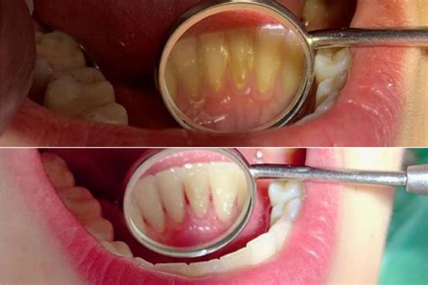 how to remove tartar build up at home