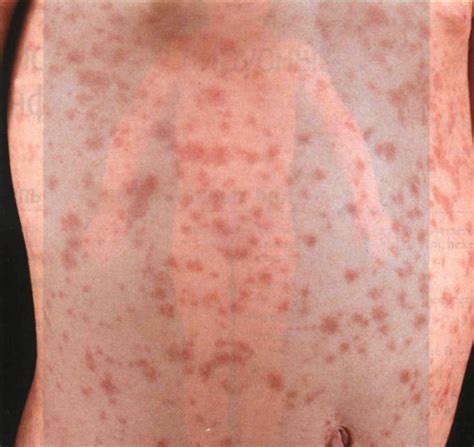 СЫПЬ ПРИ ИНФЕКЦИОННЫХ БОЛЕЗНЯХ * My dermatology