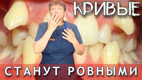Что делать, чтобы выравнять зубы. Восстановление зубов…… - YouTube