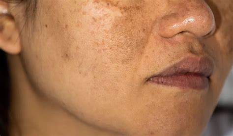 how to get rid of hyperpigmentation around mouth