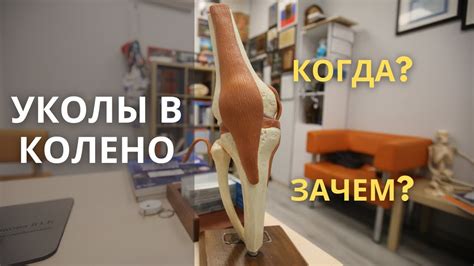 Уколы в колено: гиалуроновая кислота. Артроз - YouTube
