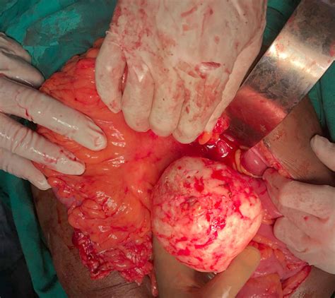The large popping cysts medical mystery that baffled doctors 7