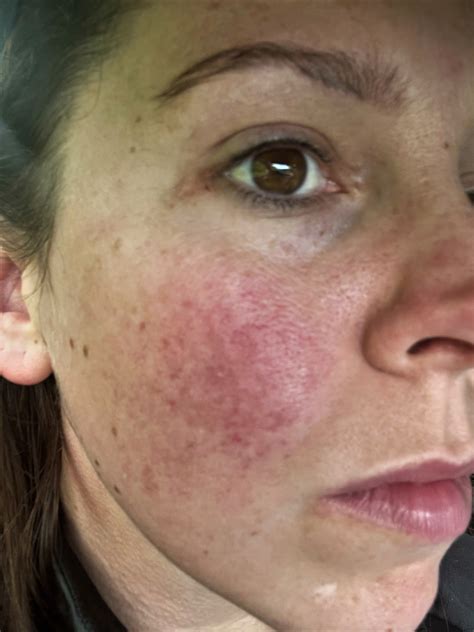 Red face during pregnancy made mum cry, until she found the cure