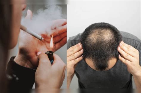 Hair Follicles Quitting at Maria Henderson blog