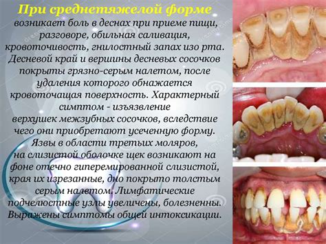 Язвенно-некротический гингивостоматит Венсана - презентация онлайн
