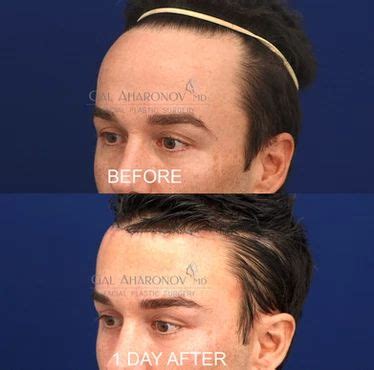 | HAIRLINE LOWERING SURGERY | Forehead reduction surgery, Forehead ...