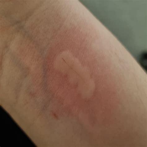 Allergic To Cat Rash at Lillie Authement blog