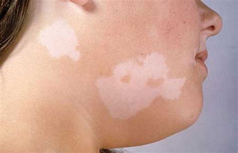 Белые пятна на лице | Kosmetologiya-dermatologiya.az