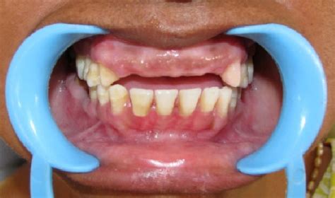 Six weeks after surgery and abutment tooth preparation. | Download ...