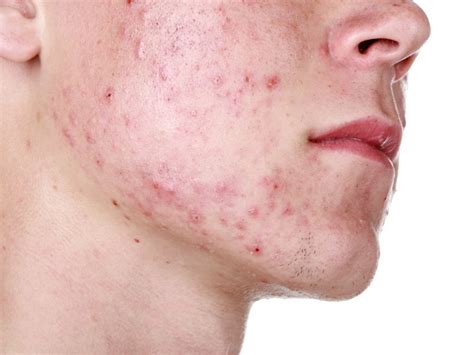 How to Get Rid of Hormonal Acne - Causes & Treatments | Styles At Life