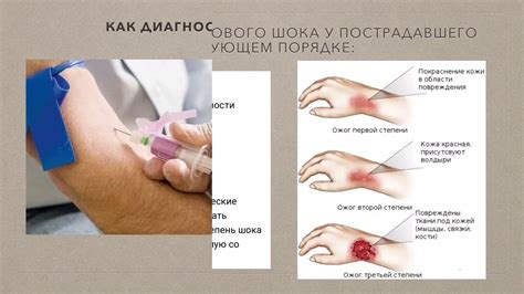 Ожоговый шок - YouTube
