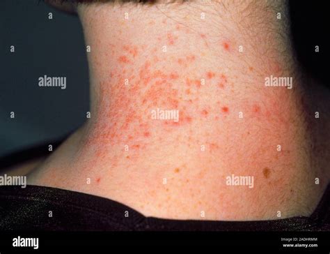 contact dermatitis close    neck    year  girl showing