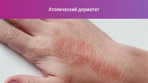 Аллергия на руках: всё о причинах и лечении