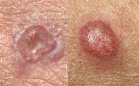Main Type of Skin Cancer — Their Differences, Histology and Prevention ...