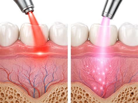 Can Red Light Therapy Regrow Gums