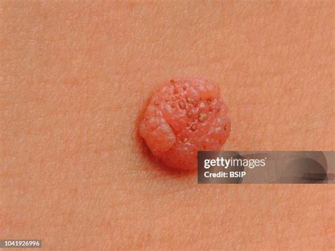 13 Intradermal Nevus Stock Photos, High-Res Pictures, and Images ...