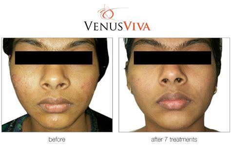 Venus Viva Procedure | Beautiful Skin Treatment on Maui