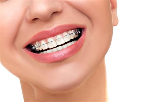 phases  braces treatment smilebliss