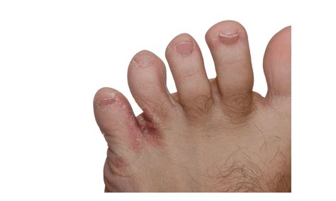 understanding  treating erythrasma   toes  acacia foot