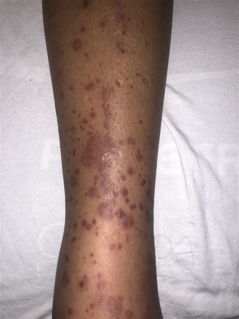 Purpura Rhumatoïde Enfant 4