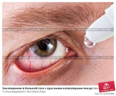 раскаленный статус: капилляры в глазах картинки