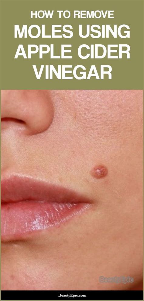 How To Remove A Mole With Apple Cider Vinegar | Skin moles, Mole ...