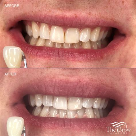 Teeth Treat: Best teeth whitening kits for stained teeth