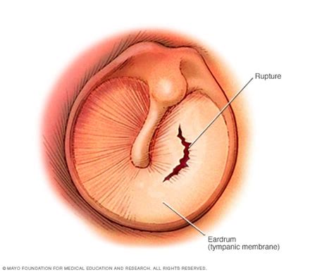 how long for a ruptured eardrum to heal