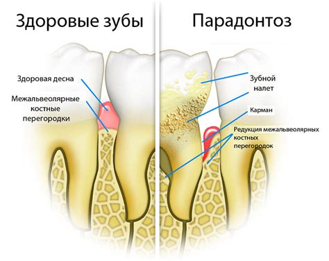 Лечение пародонтоза Стоматология №2 в Ижевске