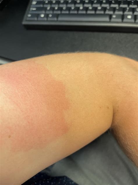 Testosterone Leaking Out After Injection