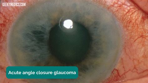 Examination of the Eyes and Vision - OSCE Guide | Geeky Medics