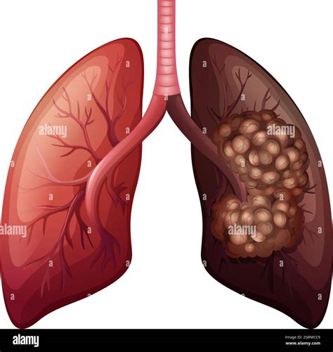 Lung Cancer Cells Diagram