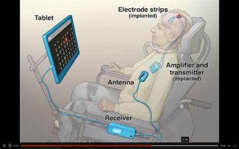 Fully implanted brain-computer interface in a locked-in patient with ...