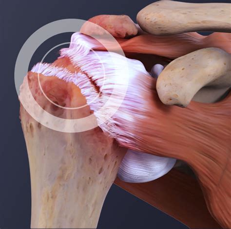 treatment  shoulder impingement syndrome