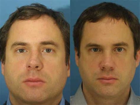 Upturned Nose Ethnicity