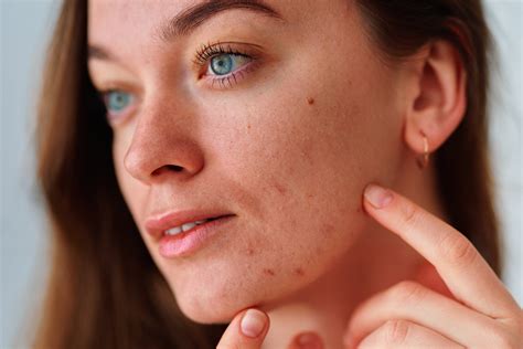 Dry Skin on the Face - Skin Science Clinic
