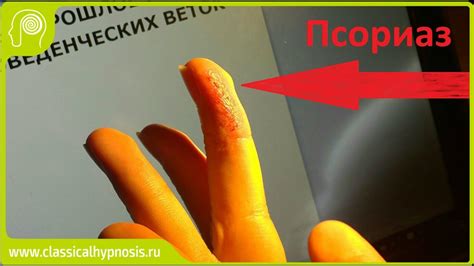 "Лечение" псориаза в гипнозе: сперва вызвать, потом убрать ...