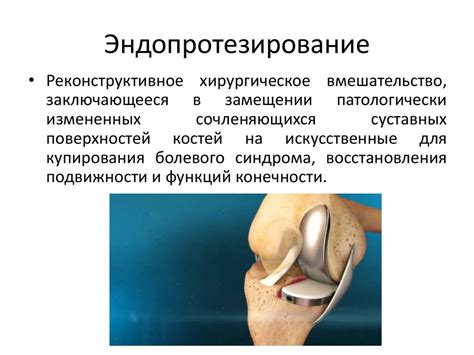 Эндопротезирование тазобедренного, коленного суставов - презентация онлайн