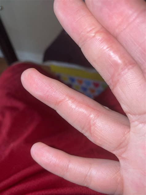 Flexor Tendon repair surgery scars. They healed pretty well. A lot