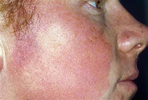 Keratosis Pilaris (KP): Treatment, Causes, Symptoms, Diet & Pictures ...