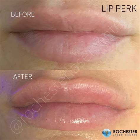 HydraFacial Lip Perk