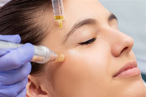 Prp Microneedling Near Me