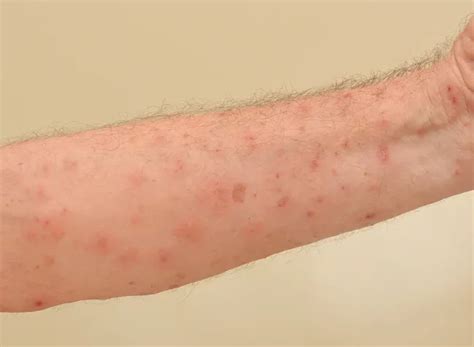 gejala scabies kudis  tanda tanda sembuhnya