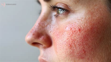 treatment  rosacea london dermatologist explains