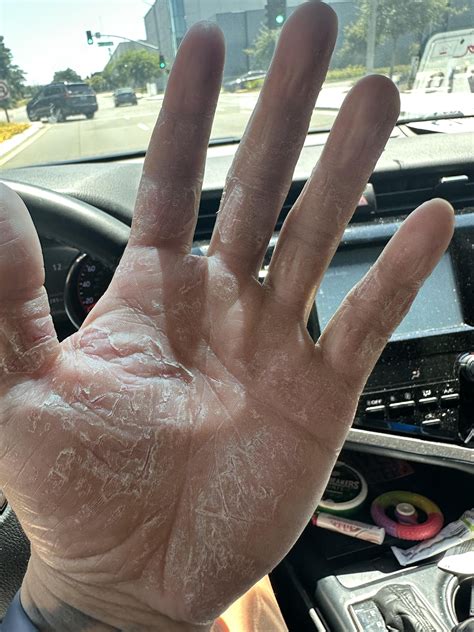 Fungal infection on hand or eczema? : r/Dermatology