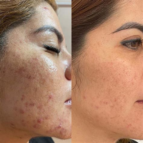 bha chemical peel       booking