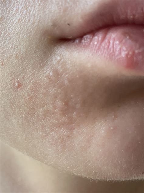 Bumps on chin (sebaceous hyperplasia?) – General acne discussion – Acne ...