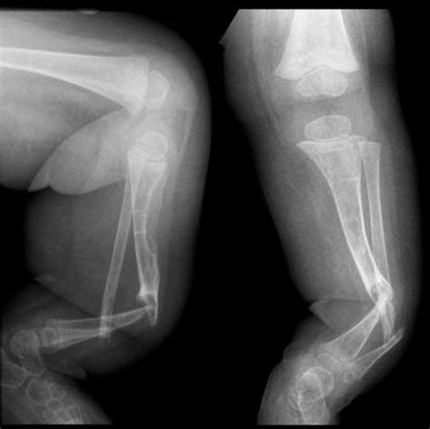 Congenital Pseudarthrosis of Tibia | Bone and Spine